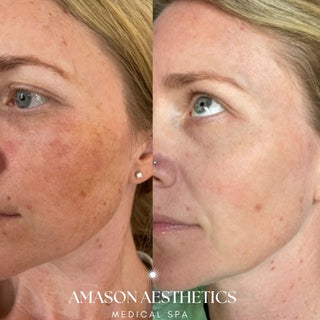 BBL - Full Face + Neck