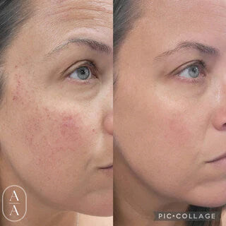 A before and after image of the face after a patient received Lumecca IPL Laser Treatments in the Jacksonville, FL area
