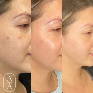 Before and after images of the face after a patient received Lumecca IPL Laser Treatments in the Jacksonville, FL area