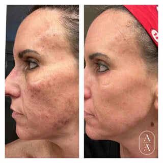 Before and after images of the face after a female patient received Lumecca IPL Laser Treatments in the Jacksonville, FL area