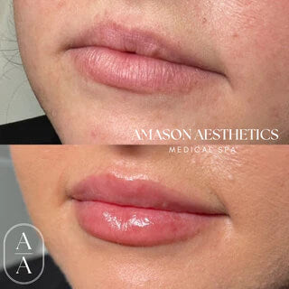 A close-up image of before and after a patient received lip fillers in the Jacksonville, FL area