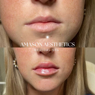 Before and after a patient received lip fillers in the Jacksonville, FL area