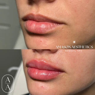 An image of before and after a patient received lip fillers in the Jacksonville, FL area