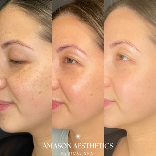 Three images of a patient's face that was transformed with Lumecca IPL Laser Treatments in the Jacksonville, FL area