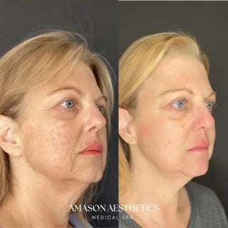 Halo+BBL -  Full Face + Neck+ Chest