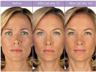 Unveiling the Facts and Fiction of Botox: A Comprehensive Guide