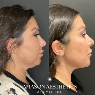 A before and after image of a jawline transformation with fillers in the Jacksonville, FL area