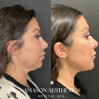 Jawline Filler Transformation