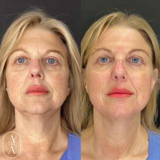 Halo - Full Face + Neck Package (2)