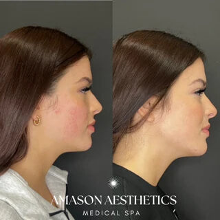 Before and after a jawline transformation with fillers on a patient in the Jacksonville, FL area