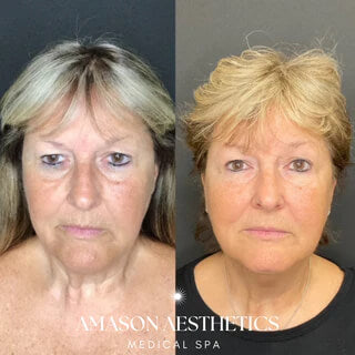 An image of before and after a patient received the Morpheus8 RF Microneedling Treatment in the Jacksonville, FL area