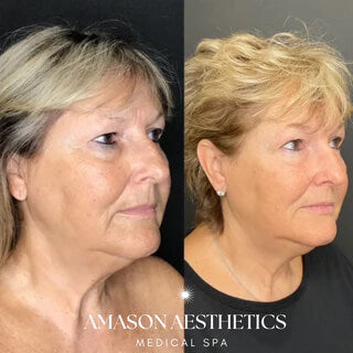 A side view of before and after a patient received the Morpheus8 RF Microneedling Treatment in the Jacksonville, FL area
