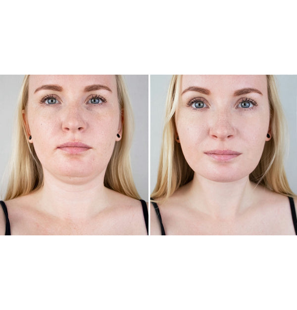 Kybella Injections in Saint Johns and St. Augustine, FL | Double Chin Removal Amason Aesthetics Kybella Injections in Saint Johns and St. Augustine, FL | Double Chin Removal Amason Aesthetics